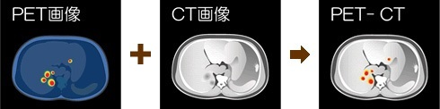 PET-CT の検査イメージ