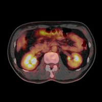 PET-CT