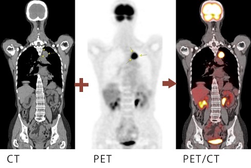 「PET/CT検査」とは