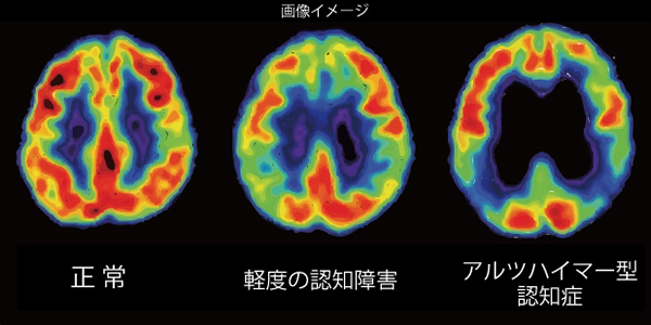 Pet検査の種類と最新情報 がん検査と基礎知識 Pet検査ネット