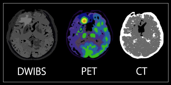 DWIBS法、PET検査、CT検査の診断画像の比較イメージ