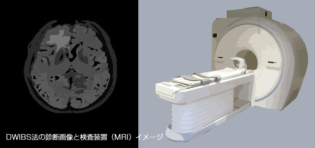 DWIBS法の診断画像と検査装置（MRI）イメージ