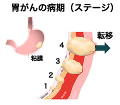 がんの病期・ステージ