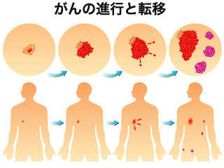 腫瘍の発展と転移