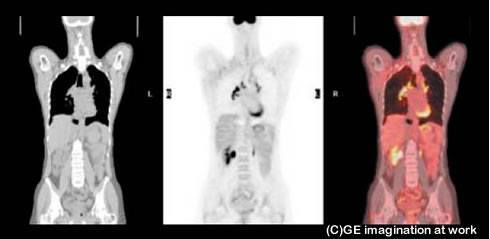 PET-CT画像が有効であった例