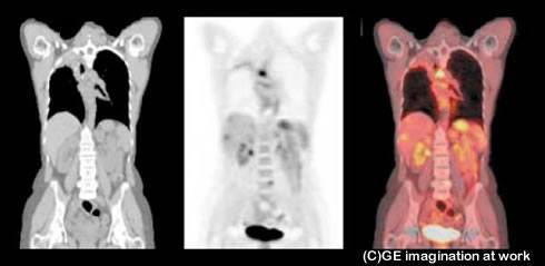 PET-CTで目的部位以外の異常がみつかった例