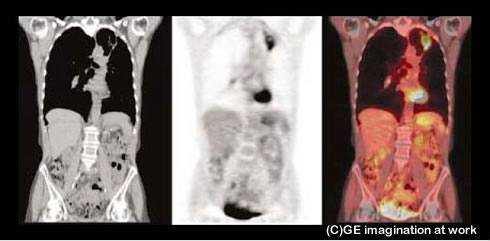 PET-CTで診断に変更があった例