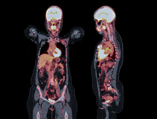 PET-CTの画像イメージ