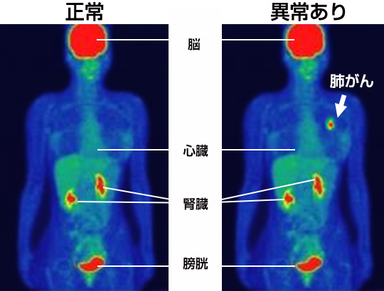 FDG検査薬とがん細胞のイメージ