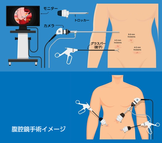 腹腔鏡手術イメージ