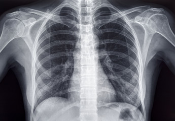 胸部X線検査