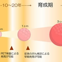 がんについて