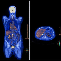 PET-CT